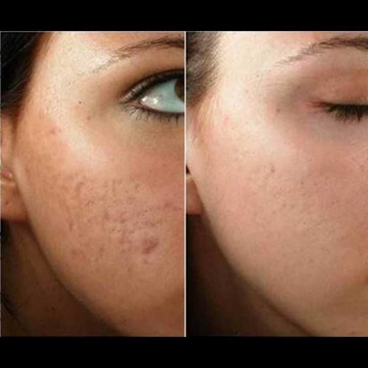 تخصصی پی آر پیprpحرفه ای بوتاکس ژل حجامت70فیلر فصد|خدمات آرایشگری و زیبایی|اصفهان, وحید|دیوار