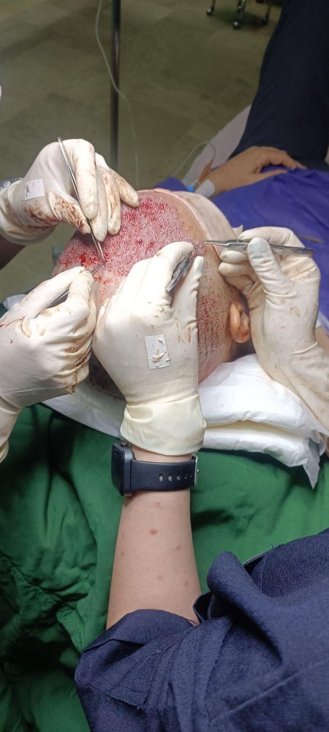 کاشت مو ابرو درمرکزجراحی بیمارستانی نه کلینیک ومطب|خدمات آرایشگری و زیبایی|تهران, فردوسی|دیوار