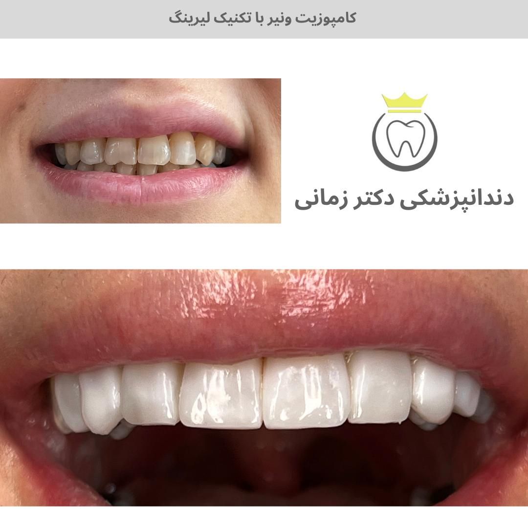 کامپوزیت و لمینت دیجیتال دندان با اقساط بلندمدت|خدمات آرایشگری و زیبایی|تهران, امیریه|دیوار