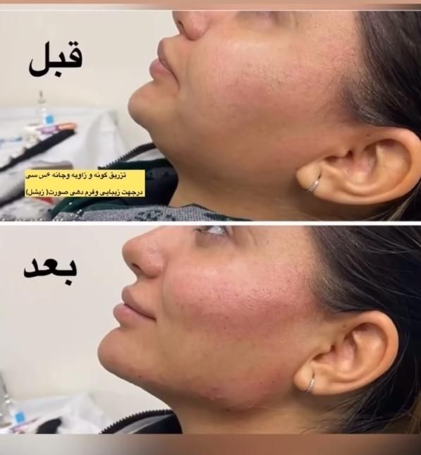 جشنواره تزریق ژل و بوتاکس،فیلرلب،مزو،هایفو،آنزیم|خدمات آرایشگری و زیبایی|کرج, عظیمیه|دیوار