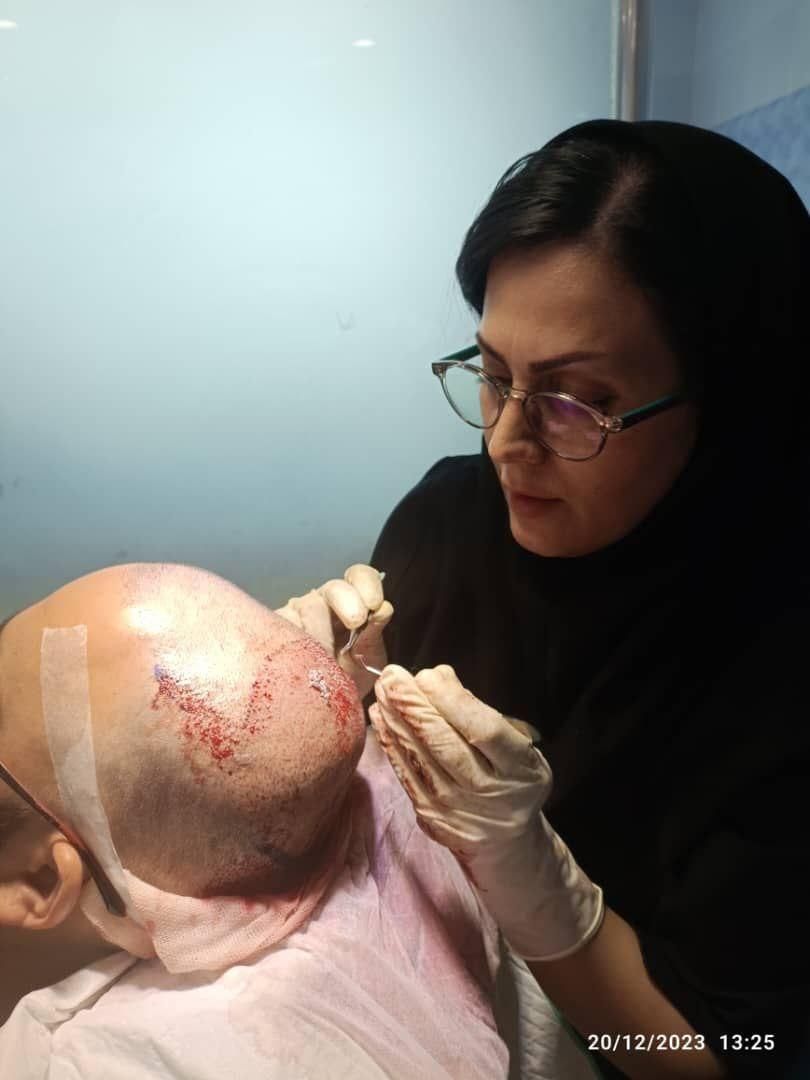 کاشت مو ، ریش و ابرو|استخدام درمانی، زیبایی، بهداشتی|شیراز, بعثت|دیوار