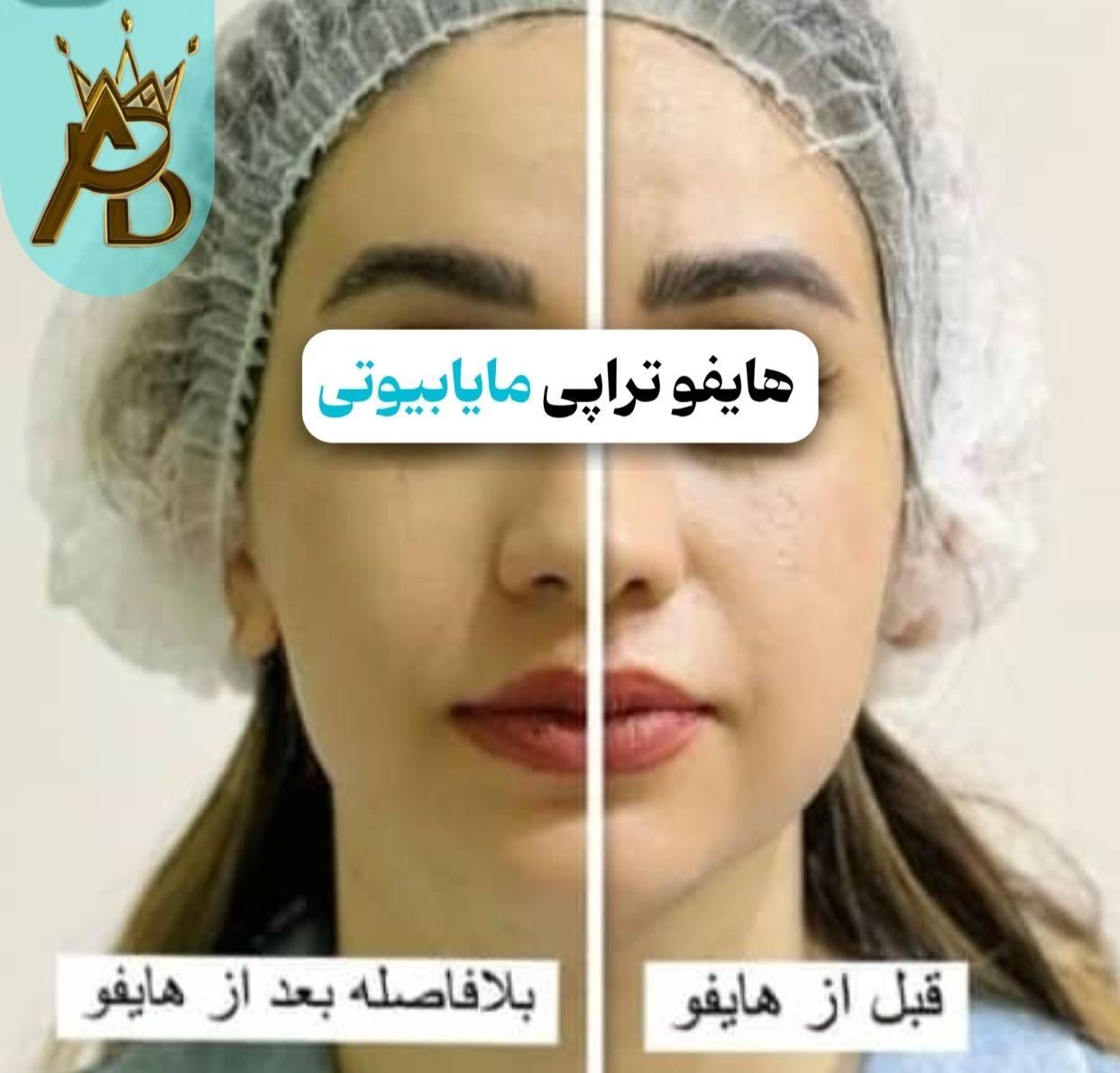 جوانسازی قوی  لیفت صورت ،روشن کننده هایفوتراپی|خدمات آرایشگری و زیبایی|یاسوج, |دیوار