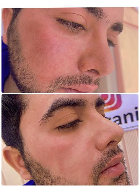 ژل بوتاکس فیلر مزوتراپی پیرسینگ و آموزش حرفه ایی|خدمات آرایشگری و زیبایی|قم, هنرستان|دیوار
