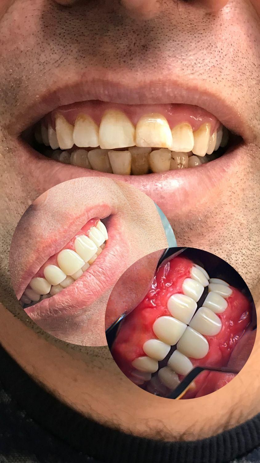 کامپوزیت دندان ، اصلاح طرح لبخند|خدمات آرایشگری و زیبایی|اصفهان, خواجو|دیوار