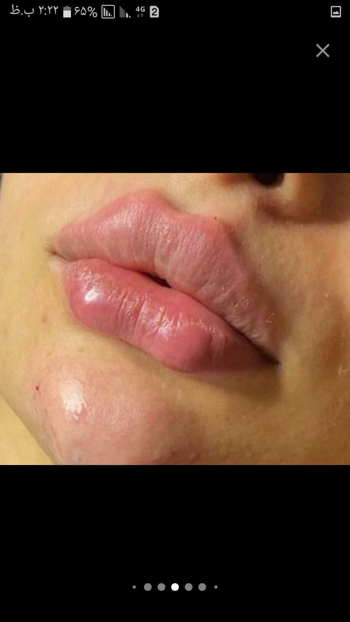 تزریق ژل وبوتاکس|خدمات آرایشگری و زیبایی|گلبهار, |دیوار