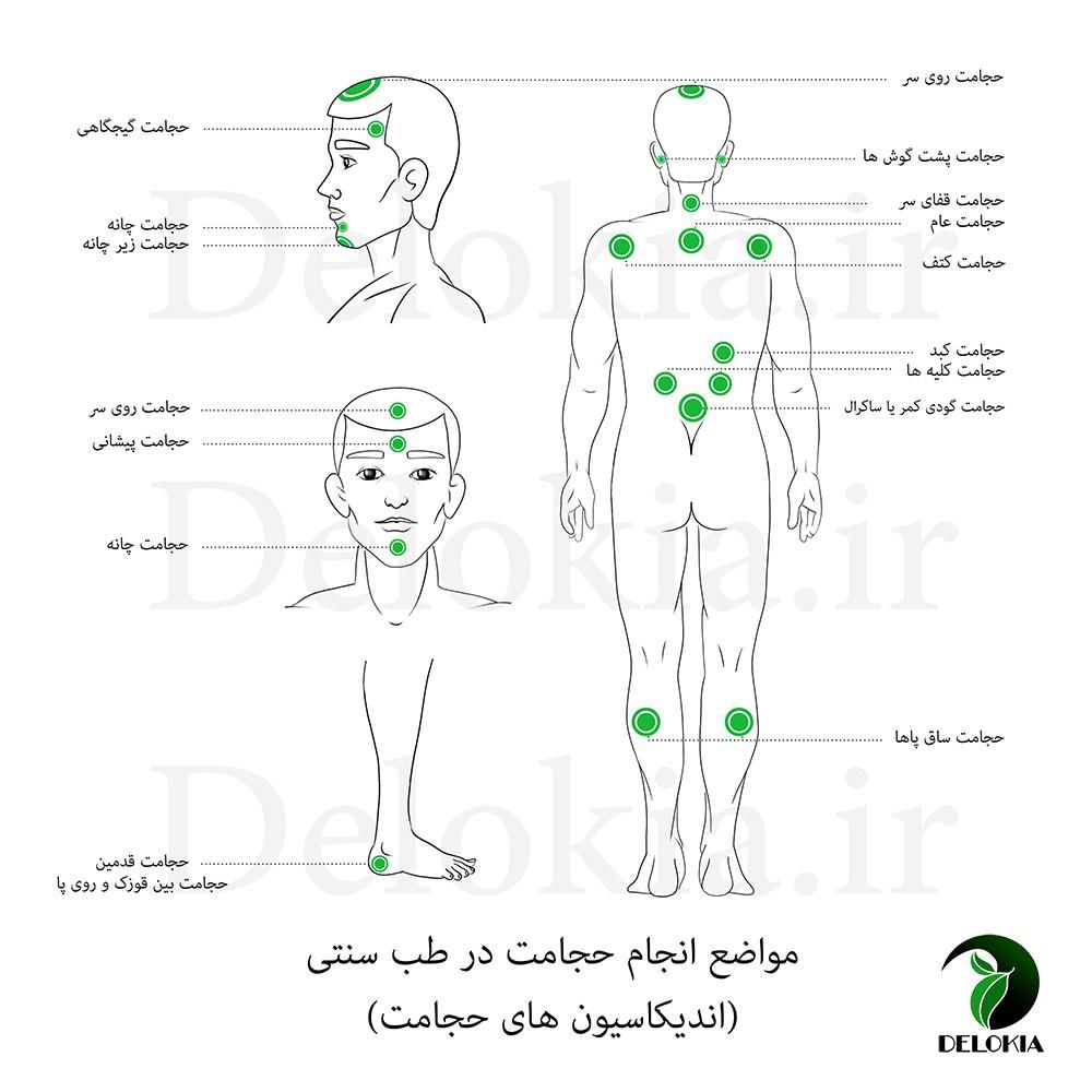 حجامت ، فصد ، زالو، بادکش ورگ گیری تخصصی|خدمات آرایشگری و زیبایی|قم, توحید|دیوار