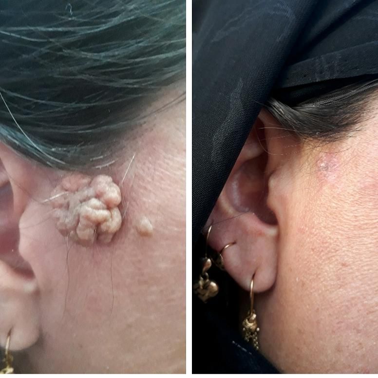 حذف خال ،میخچه ،زگیل فقط بامحلول گیاهی|خدمات آرایشگری و زیبایی|خمینیشهر, |دیوار