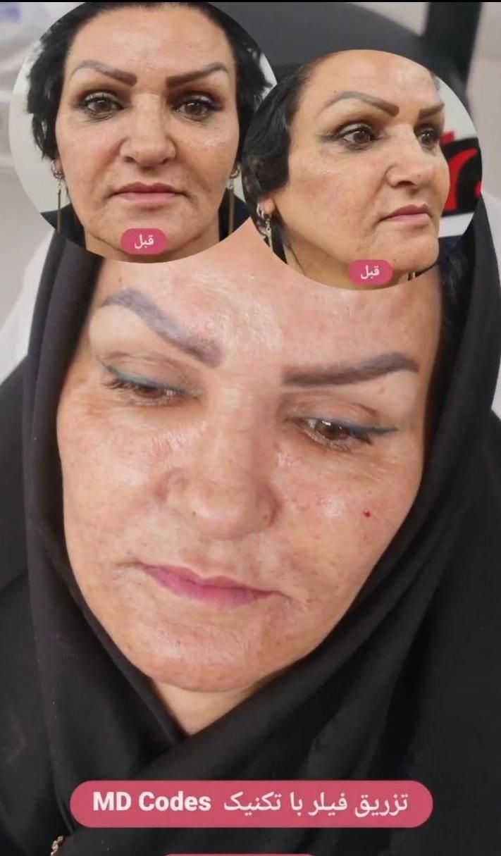 بوتاکس، ژل، چربی، لیزر، هایفوتراپی توسط پزشک|خدمات آرایشگری و زیبایی|یزد, |دیوار