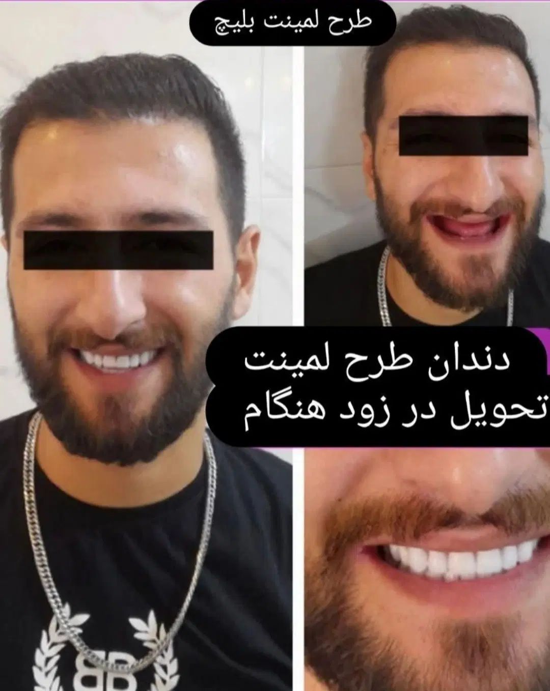 پروتز متحرک طرح لمینت (دندان مصنوعی)تا ۶ ماه اقساط|خدمات آرایشگری و زیبایی|تبریز, |دیوار