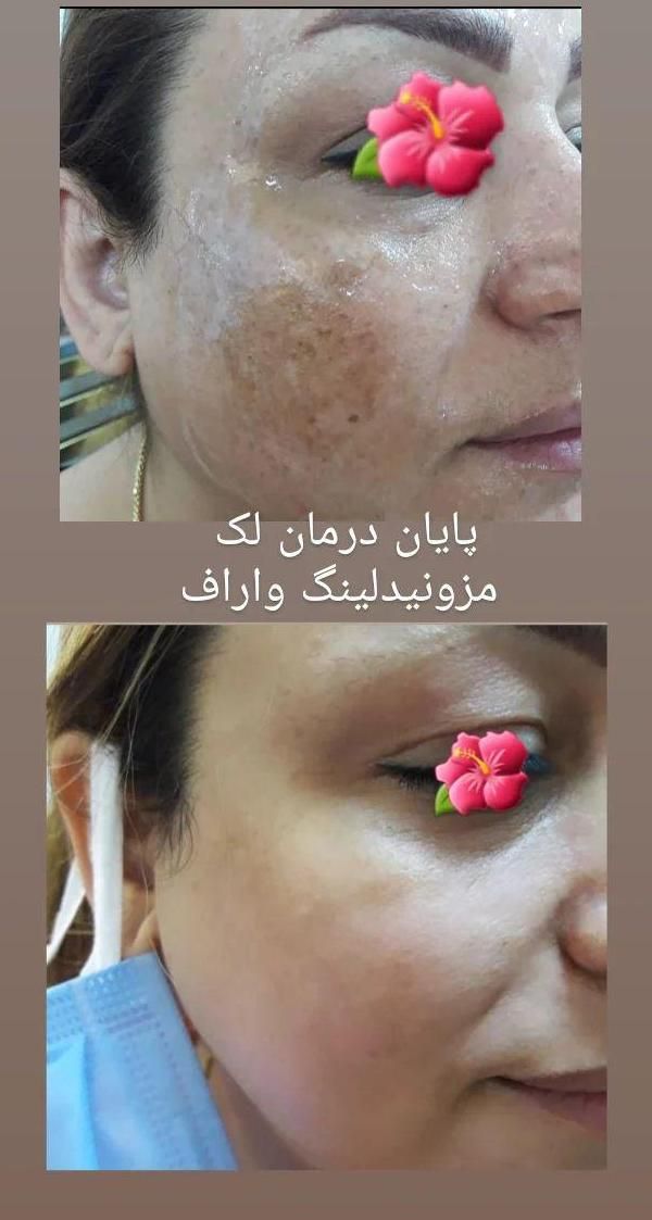 کوچک کردن بینی ورفع پف چشم بدون عمل جراحی|خدمات آرایشگری و زیبایی|مشهد, کوثر|دیوار