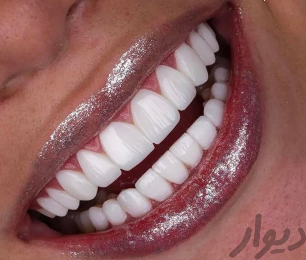 امیپلنت،لمینت،کامپوزیت و تمامی خدمات دندانپزشکی|خدمات آرایشگری و زیبایی|تهران, میرداماد|دیوار
