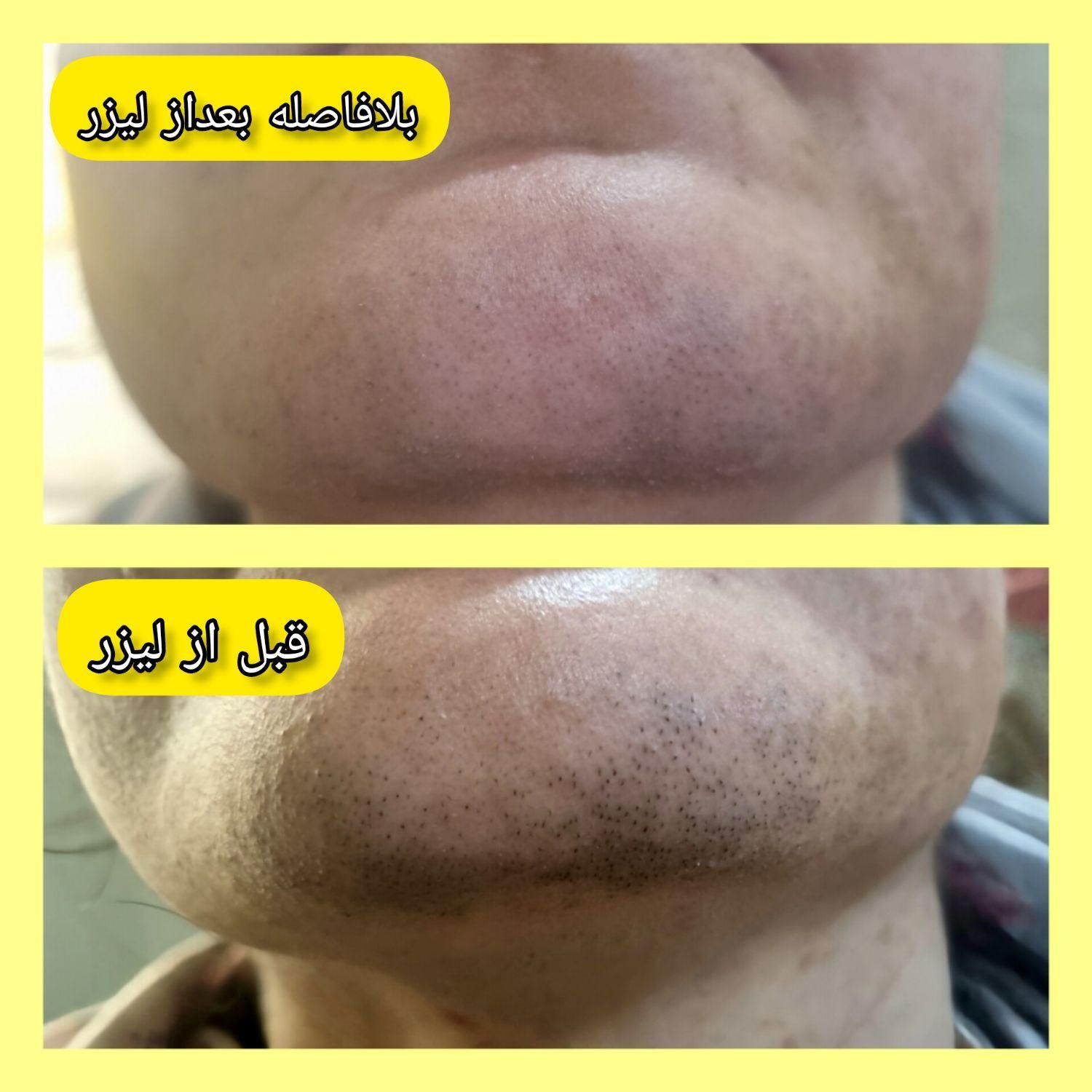 کلینیک تخصصی لیزر موهای زائد(الکساندرایت آمریکای)|خدمات آرایشگری و زیبایی|خرمشهر, |دیوار