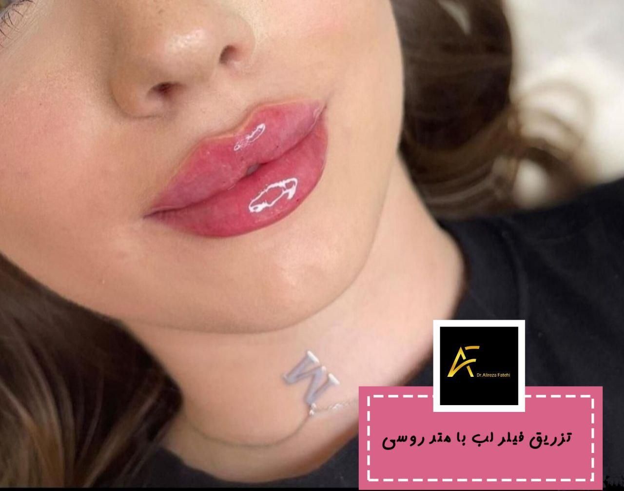 جشنواره فیلر ژل بوتاکس prpمزوتراپی لیزر توسط پزشک|خدمات آرایشگری و زیبایی|کرمان, |دیوار