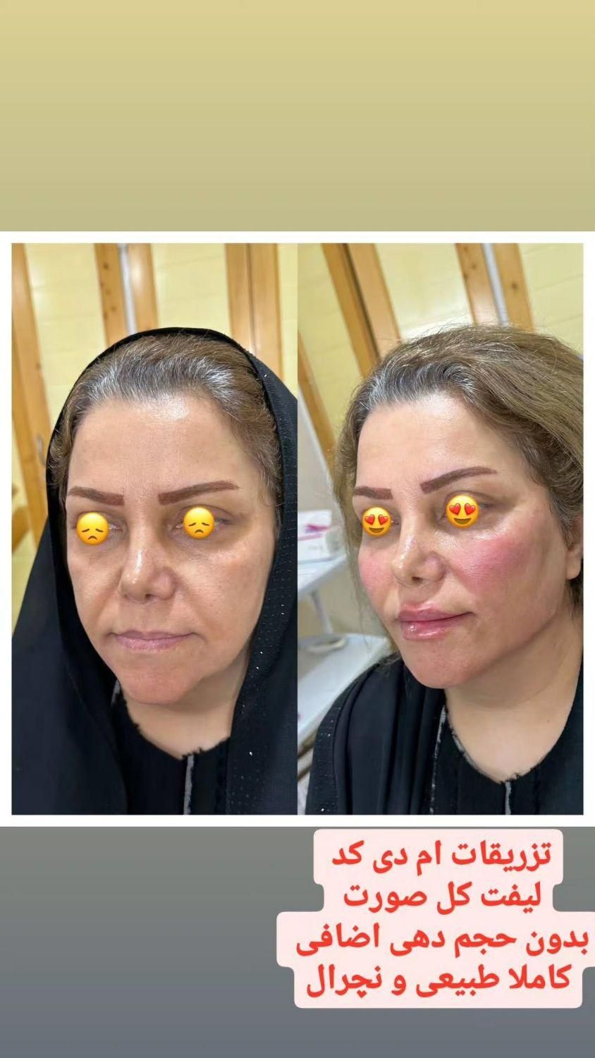 لیفت طبیعی کامل صورت ام دی کد کانتور صورت|خدمات آرایشگری و زیبایی|تهران, میرداماد|دیوار
