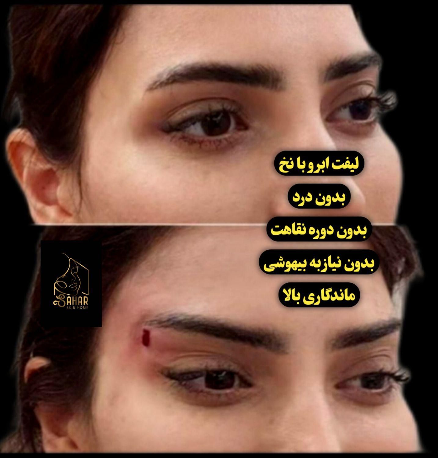 لیفت نخ معجزه جوانی و لیفتینگ صورت بدون جراحی|خدمات آرایشگری و زیبایی|شاهین‌شهر, فردوسی|دیوار