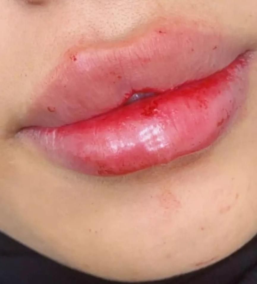 خدمات تخصصی فیلر و بوتاکس در رشت|خدمات آرایشگری و زیبایی|رشت, گلسار|دیوار