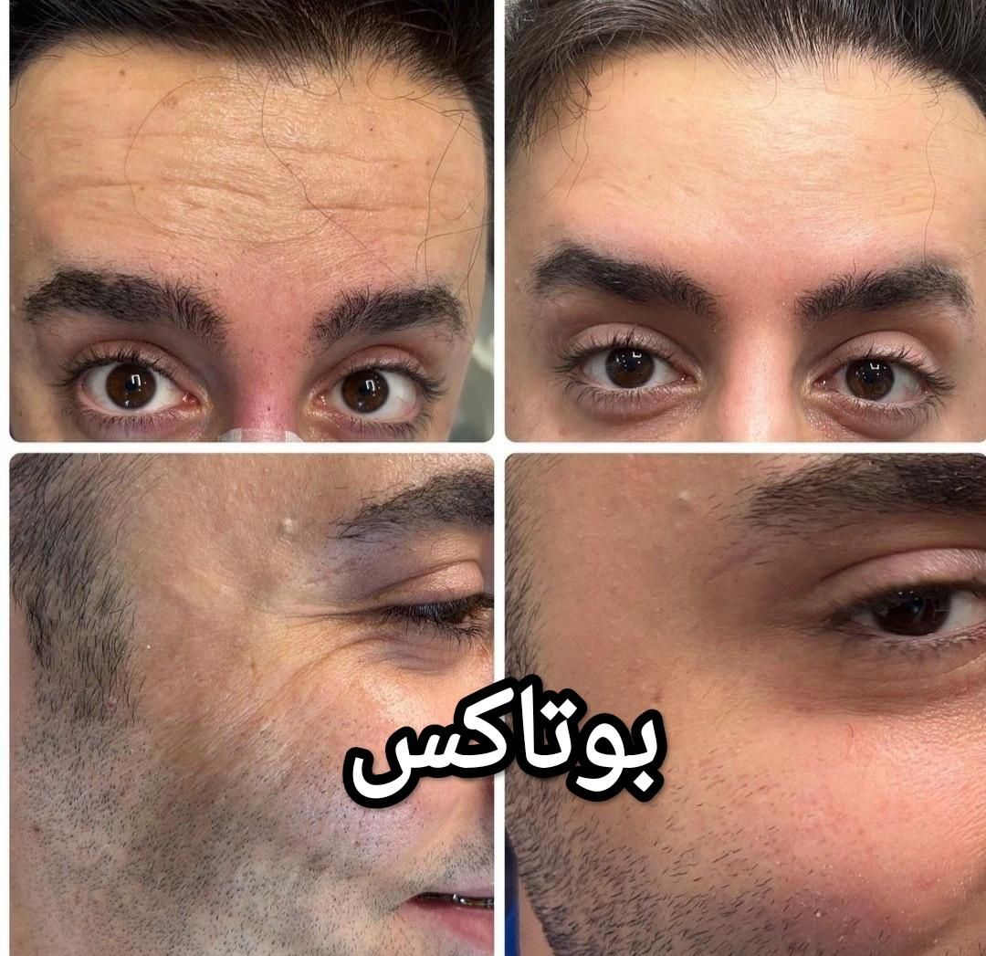 جشنواره تخفیف ویژه لیزر،ژل،بوتاکس،کلیه خدمات پزشکی|خدمات آرایشگری و زیبایی|ساری, |دیوار