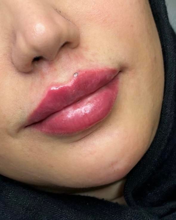 مطب تخفیف ژل و فیلر لب و صورت و بوتاکس|خدمات آرایشگری و زیبایی|قم, صفائیه|دیوار