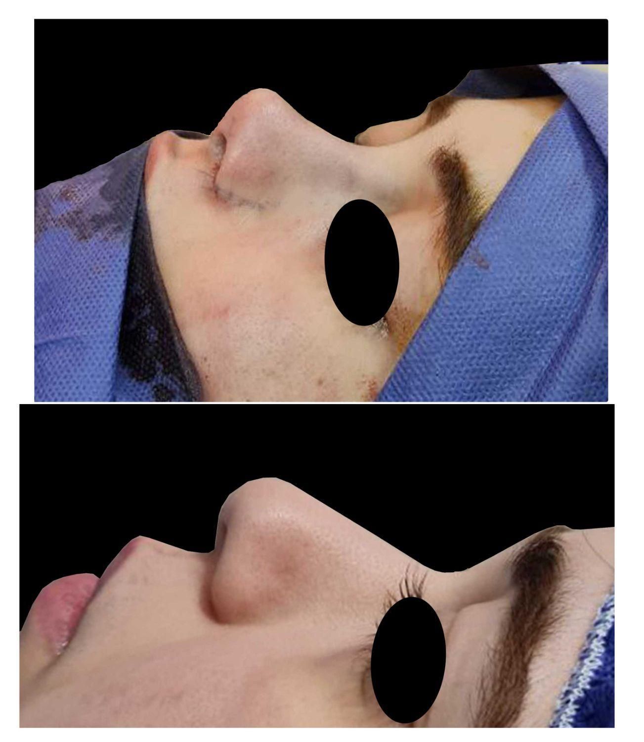 عمل زیبایی بینی(شوش)|خدمات آرایشگری و زیبایی|شوش, |دیوار