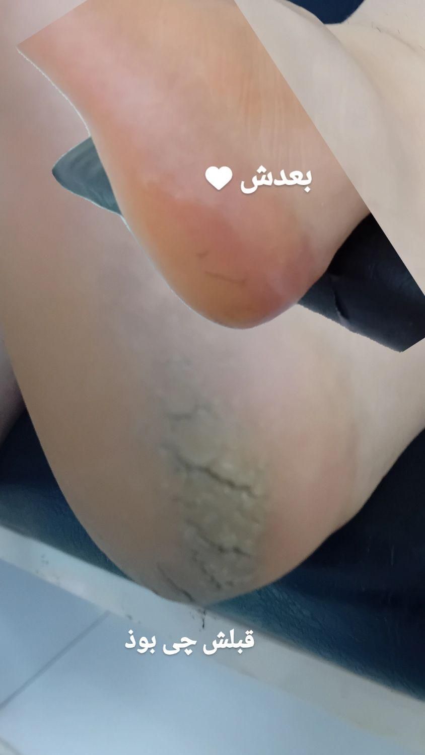 پدیکور تخصوصی درمان ترک کف پا|خدمات آرایشگری و زیبایی|مشهد, امام خمینی|دیوار