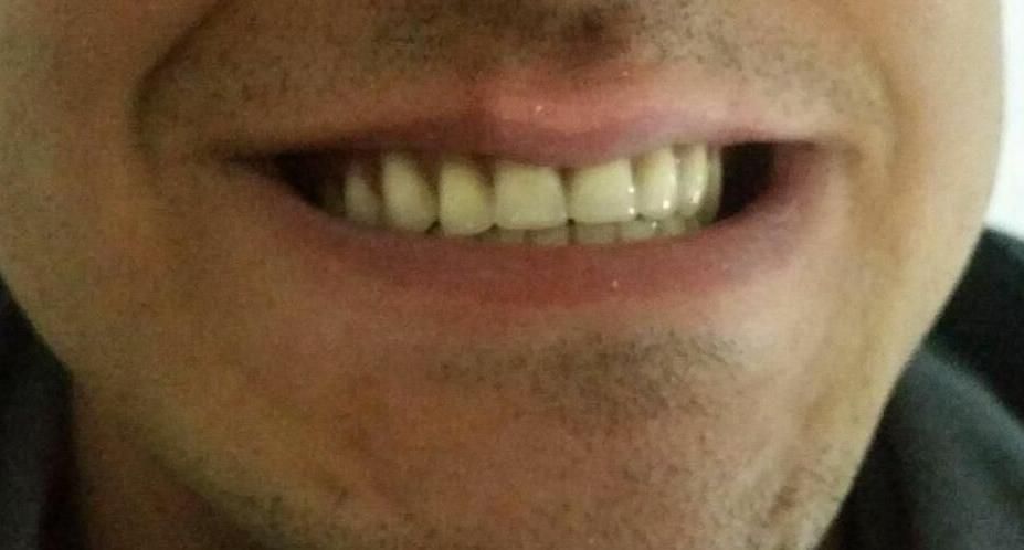 دندان مصنوعی متحرک (تحویل ۳ روزه)|خدمات آرایشگری و زیبایی|کرمانشاه, |دیوار