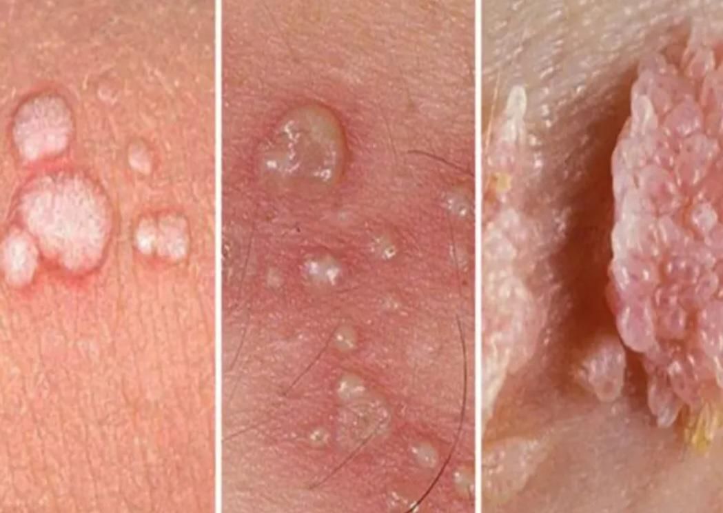 درمان زگیل،تبخال تناسلی خانمهاو آقایان،درمطب متخصص|خدمات آرایشگری و زیبایی|تبریز, |دیوار