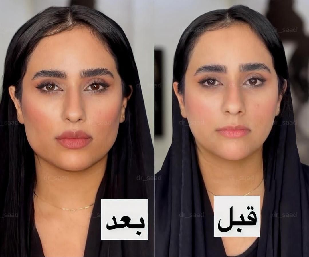 ژل لب بوتاکس لیزر فیلر هایفوبلفاروپلاستی|خدمات آرایشگری و زیبایی|مشهد, فرهنگ|دیوار