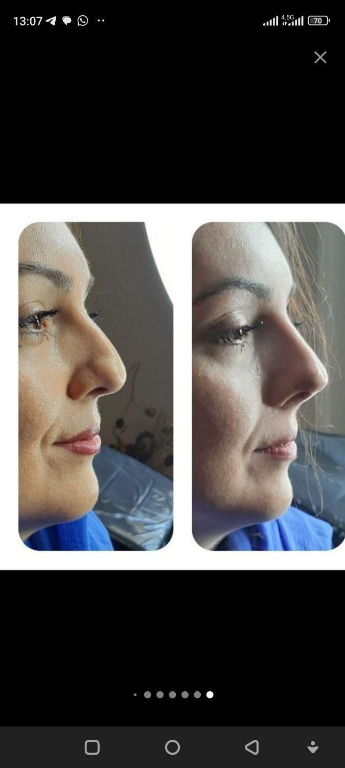 لیفت بینی بانخ|خدمات آرایشگری و زیبایی|تبریز, |دیوار