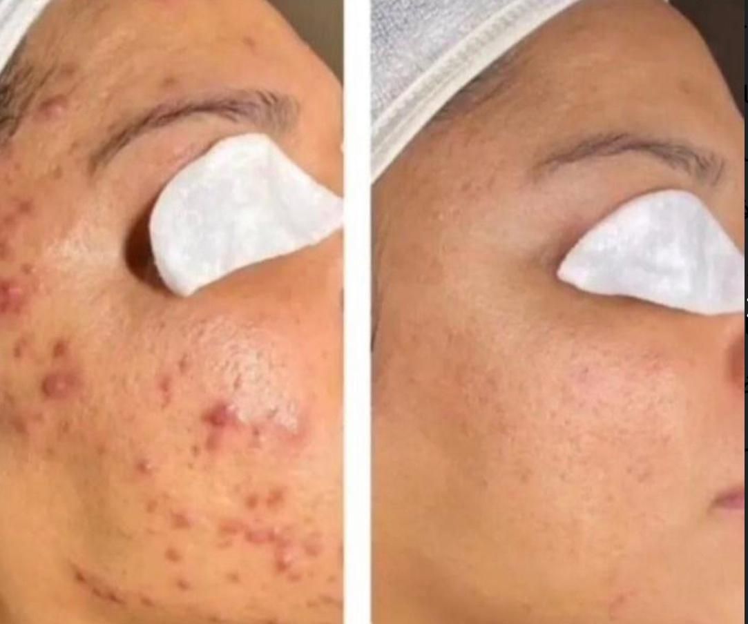 خدمات وآموزش پاکسازی پوست فیشیال فقط ویژه بانوان|خدمات آرایشگری و زیبایی|مشهد, طلاب|دیوار
