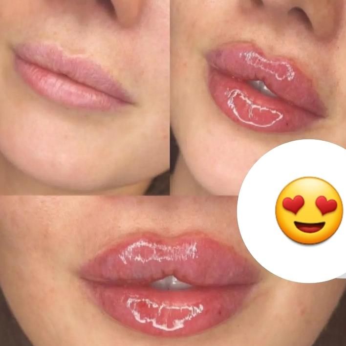 فیلرلب،بوتاکس،لیفت صورت،هایفو|خدمات آرایشگری و زیبایی|تهران, صادقیه|دیوار
