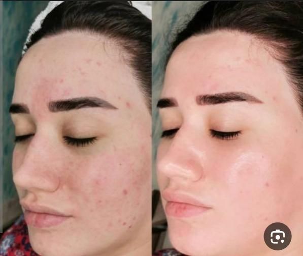 تخفیفات مدل ژل بوتاکس مزو،پاکسازی و جوانسازی صورت|خدمات آرایشگری و زیبایی|مشهد, طلاب|دیوار