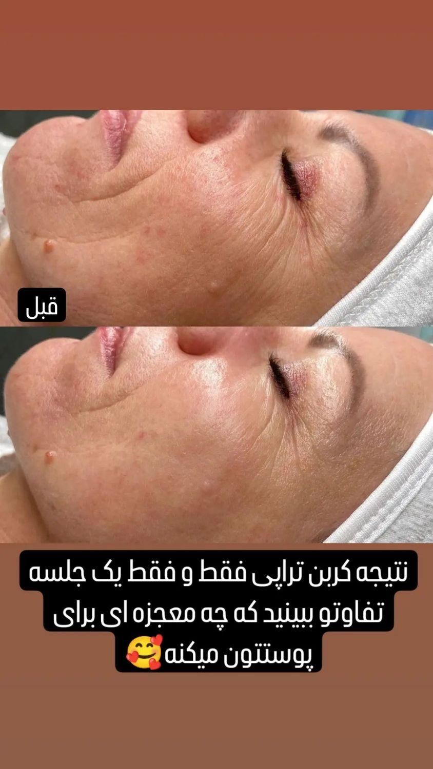 کربن هالیوودی و ریمو تتومشکی و رنگی|خدمات آرایشگری و زیبایی|ارومیه, |دیوار