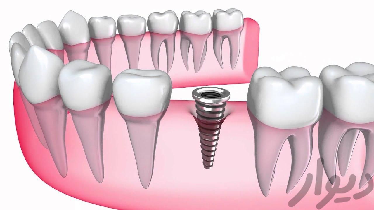 ایمپلنت دندان دیجیتال ده دقیقه بدون درد دندانپزشکی|خدمات آرایشگری و زیبایی|تهران, گاندی|دیوار
