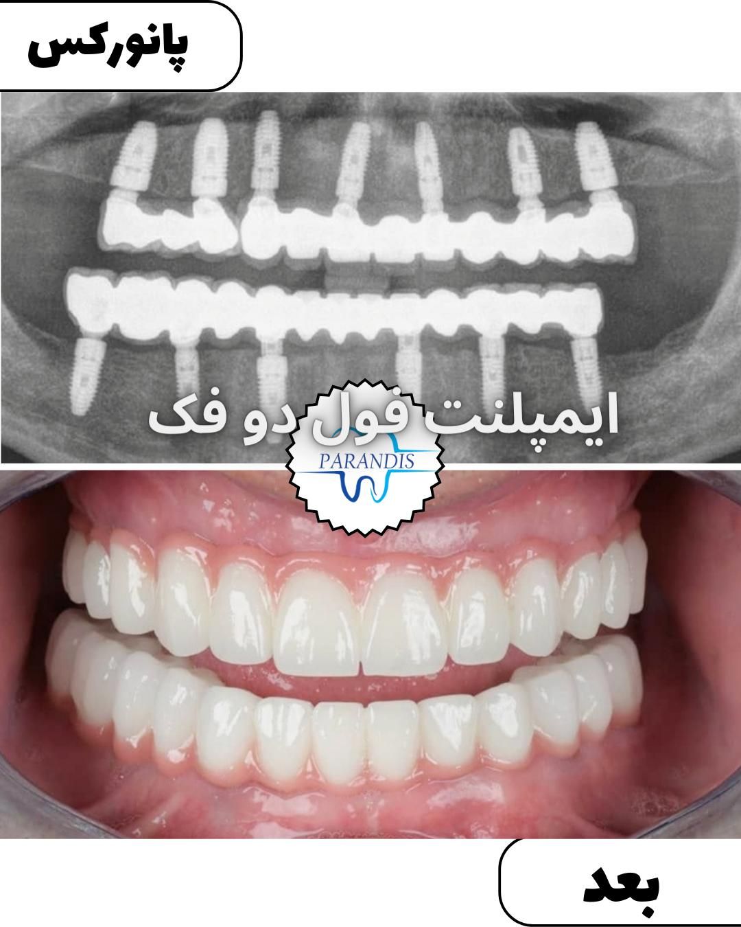 دندانپزشکی تخصصی ایمپلنت پیوند استخوان /اقساط|خدمات آرایشگری و زیبایی|تهران, پونک|دیوار
