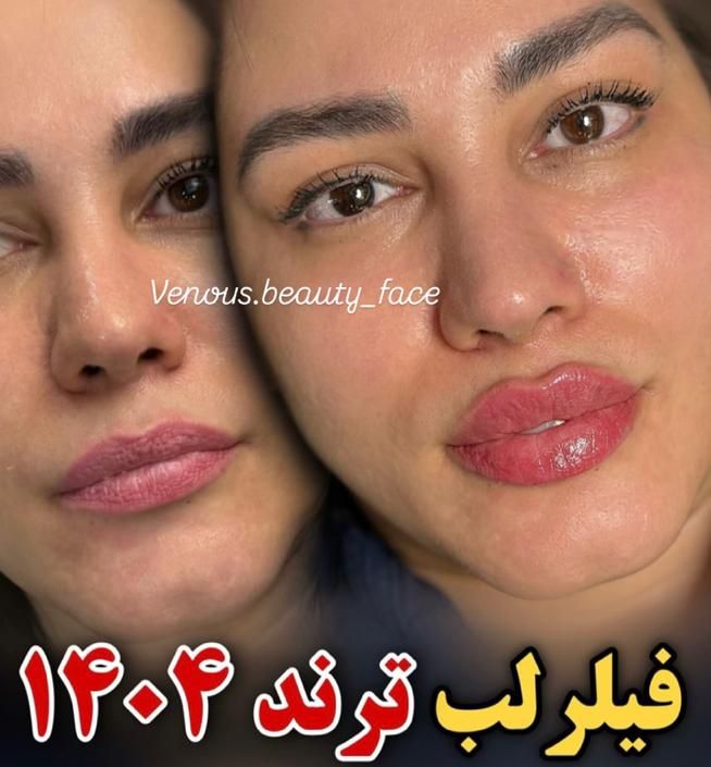 جشنواره عیدانه کلینیک50%تزریق ژللب M بوتاکس لیزر|خدمات آرایشگری و زیبایی|تهران, شهرآرا|دیوار