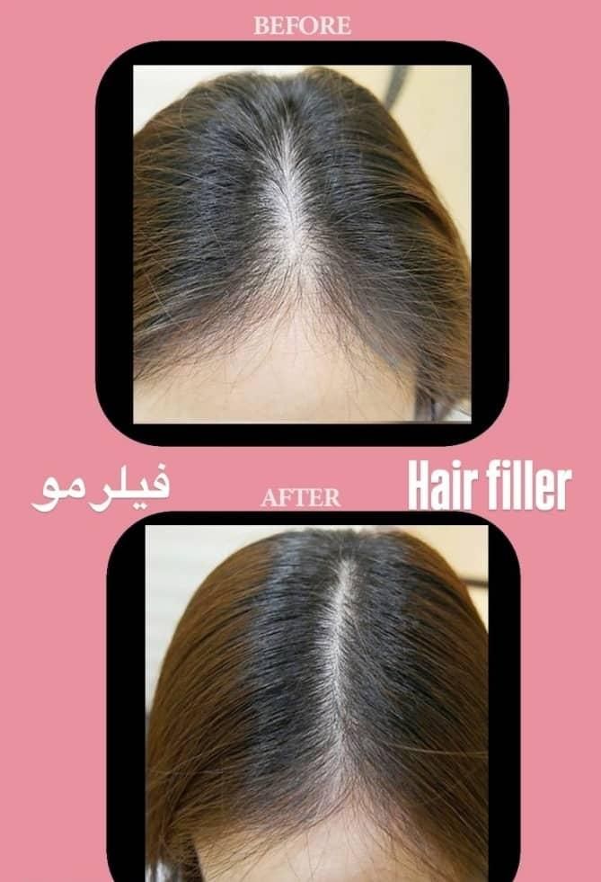 تزریق ژل لب روسی بوتاکس هایفو لیزر فیلر لیفت صورت|خدمات آرایشگری و زیبایی|تهران, ستارخان|دیوار