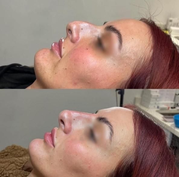 ژل لب/گونه/بوتاکس/فیلربینی/مزوپی ار پی|خدمات آرایشگری و زیبایی|مشهد, سجاد شهر|دیوار