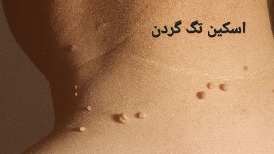 برداشتن خال زگیل میخچه باقیمت فوق العاده توسط پزشک|خدمات آرایشگری و زیبایی|اسلام‌شهر, |دیوار