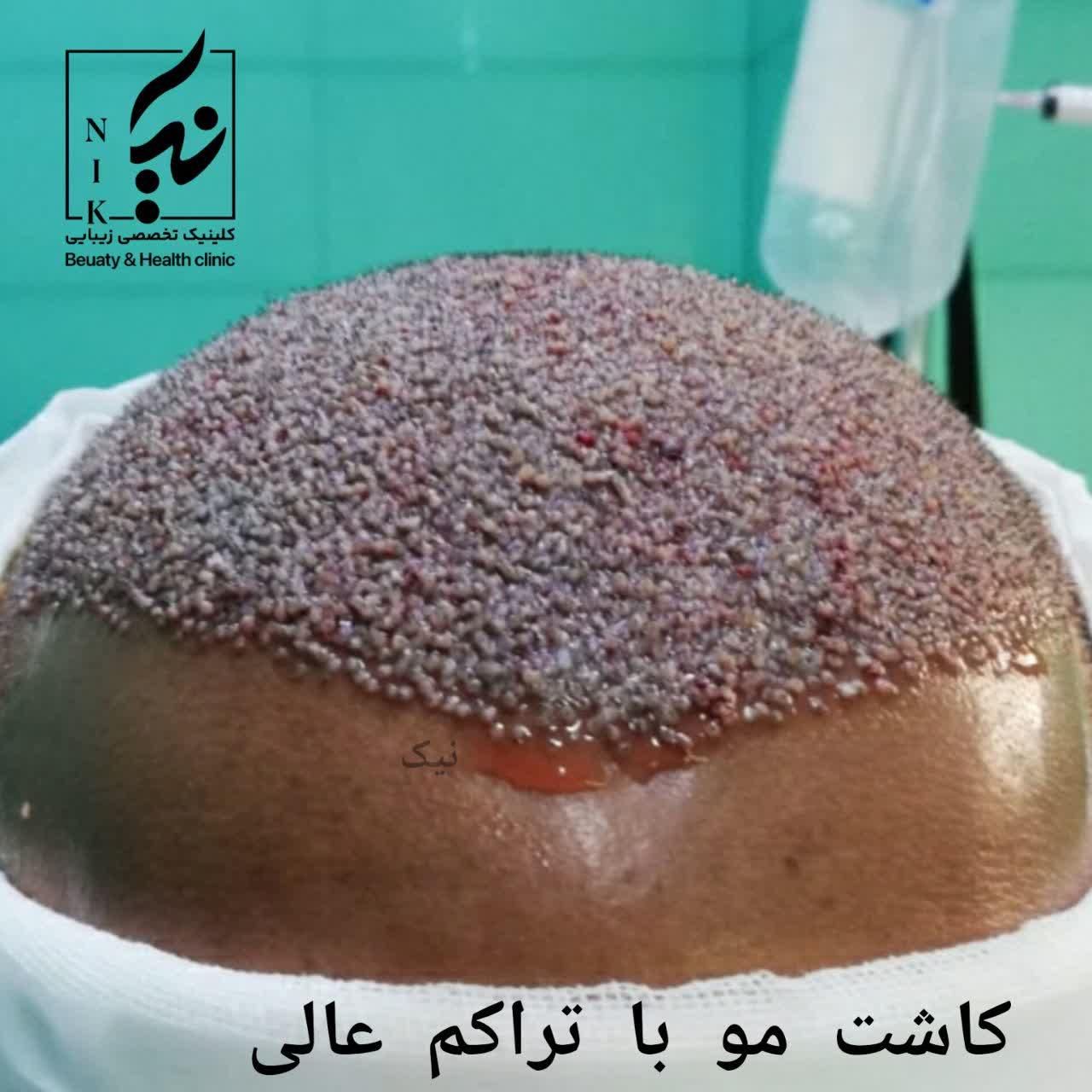 کاشت مو سوپرتراکم وی ای پی|خدمات آرایشگری و زیبایی|تهران, باغ فیض|دیوار