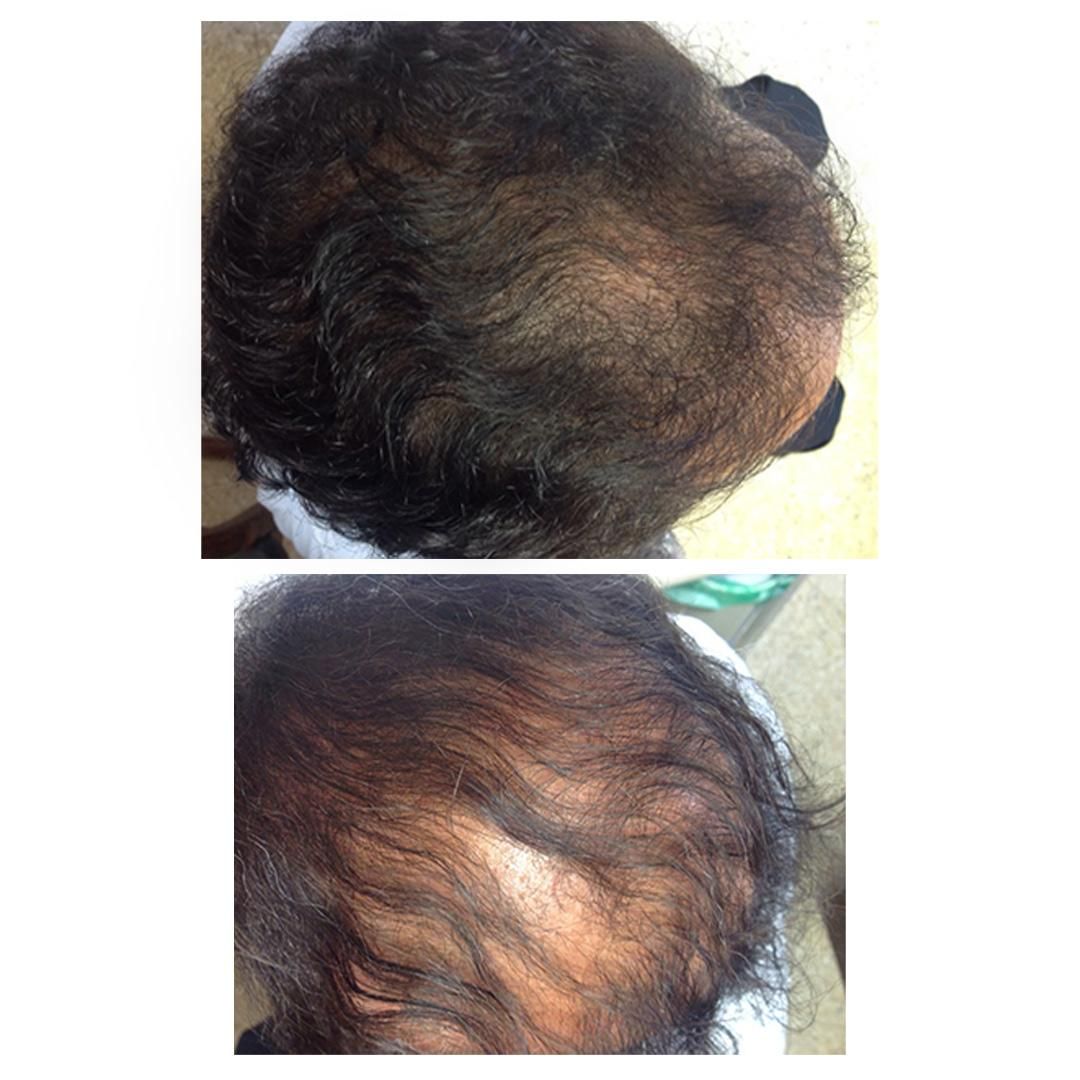 جلوگیری از ریزش مو با مزو|خدمات آرایشگری و زیبایی|شوش, |دیوار