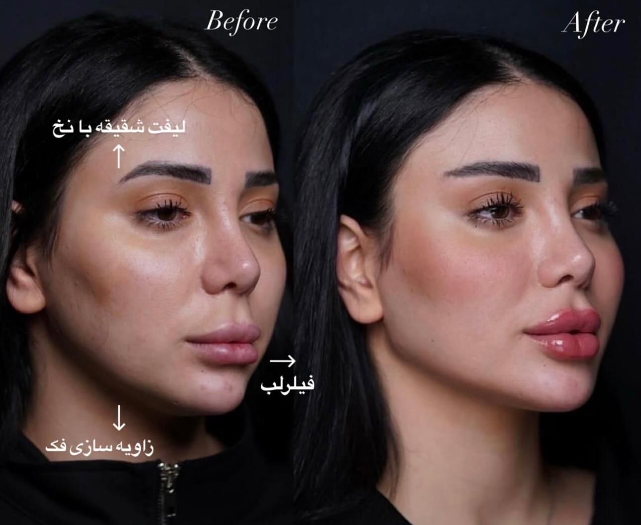 ساکشن شکم و‌پهلو بلفارو و جراحی|خدمات آرایشگری و زیبایی|مشهد, هفت تیر (حافظ)|دیوار