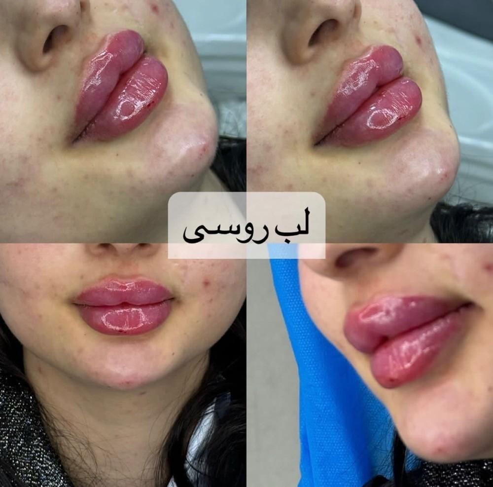 کلینیک تزریق ژل و بوتاکس انزیم پزشک|خدمات آرایشگری و زیبایی|کرج, گوهردشت|دیوار