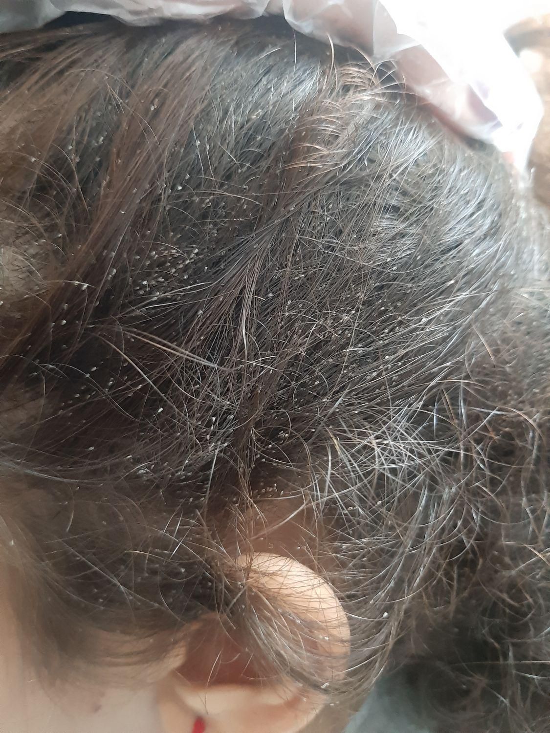 درمان صددرصدگیاهی رشک وشپش|خدمات آرایشگری و زیبایی|گرگان, |دیوار