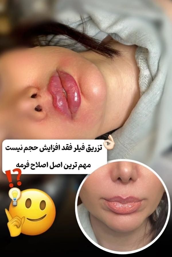 تزریق ژل و بوتاکس و فیشال تخصصی توسط پزشک|خدمات آرایشگری و زیبایی|برازجان, |دیوار