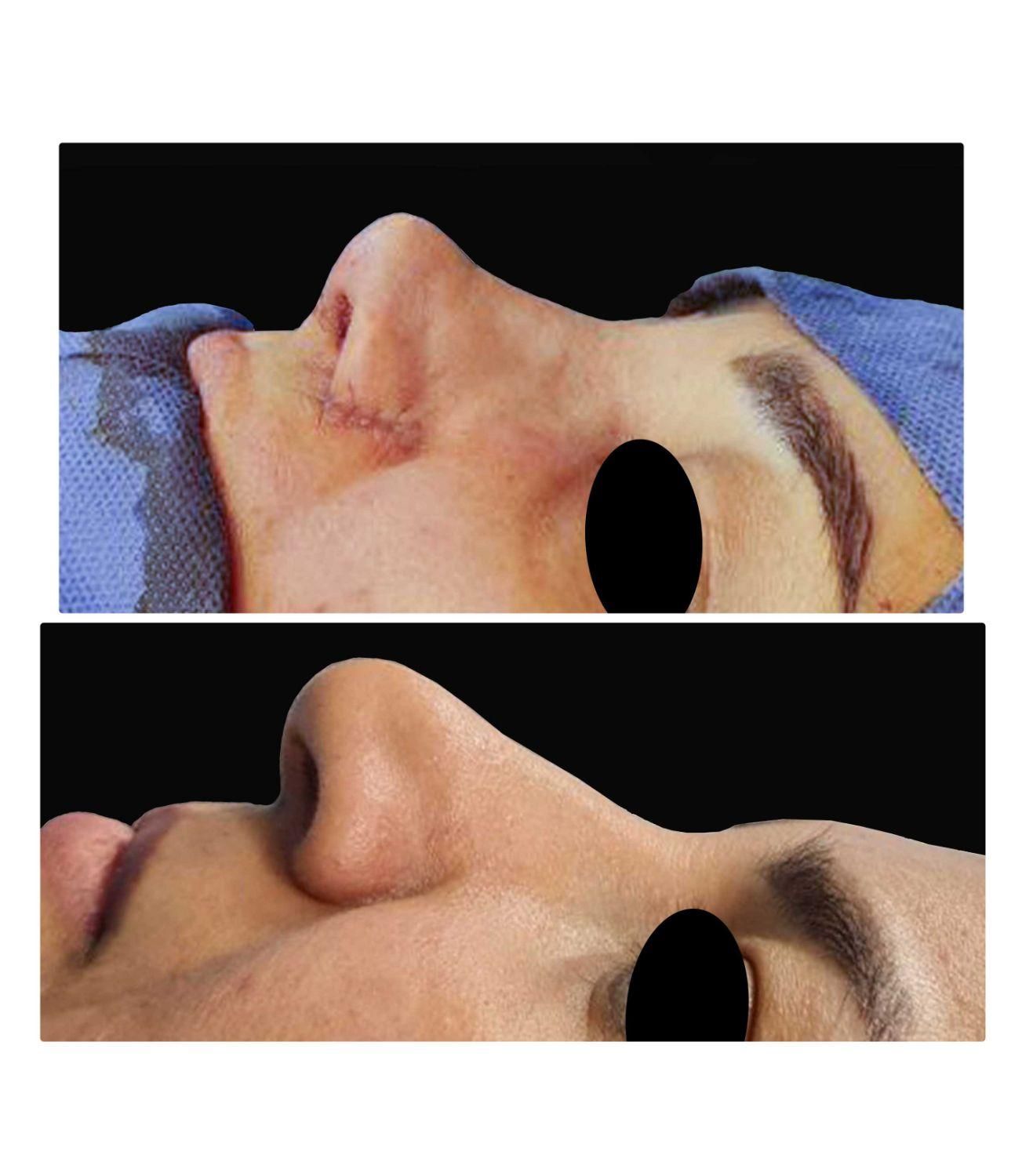 عمل زیبایی بینی، رینوپلاستی (شوش)|خدمات آرایشگری و زیبایی|شوش, |دیوار