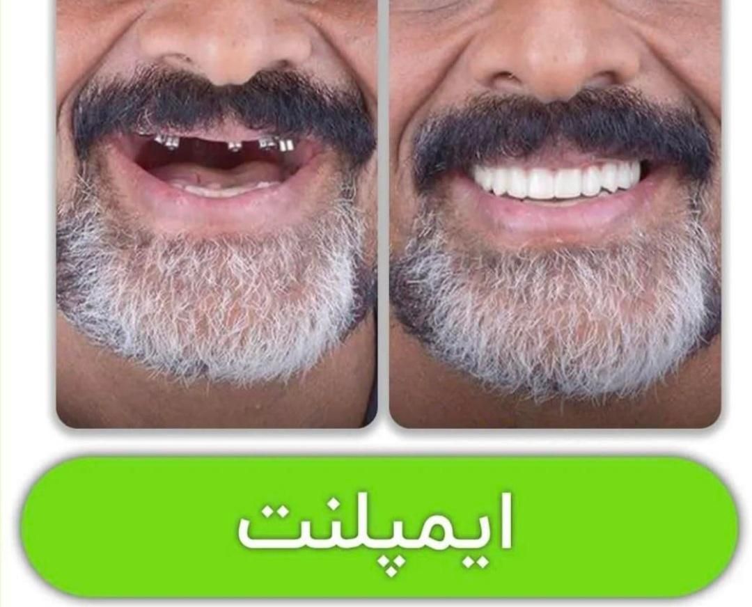 مرکز تخصصی ایمپلنت، مطب دندانپزشکی باقیمتی کم نظیر|خدمات آرایشگری و زیبایی|شیراز, قصرالدشت|دیوار