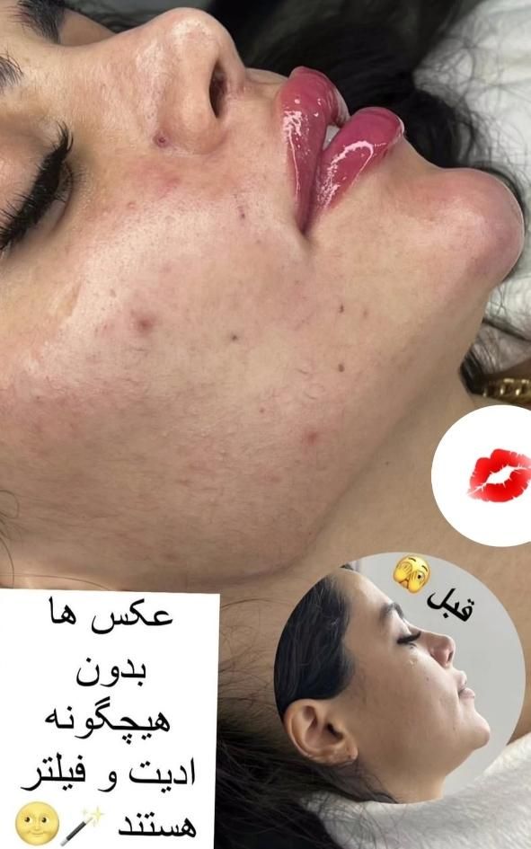 آموزش و انجام خدمات زیبایی ژل، بوتاکس ، آنزیم.مزو|خدمات آرایشگری و زیبایی|بروجرد, |دیوار