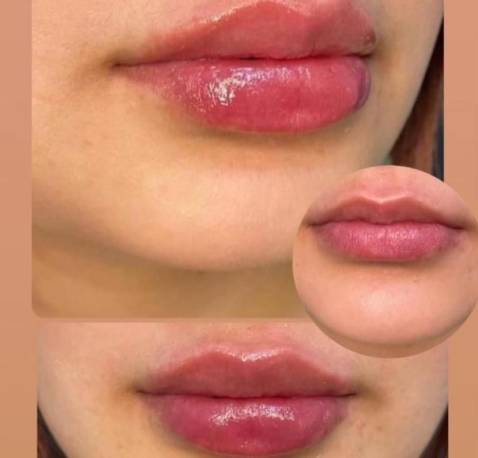 ژل لب گونه،بوتاکس،فیلر بادی صرفا توسط پزشک|خدمات آرایشگری و زیبایی|اهواز, کیانپارس |دیوار