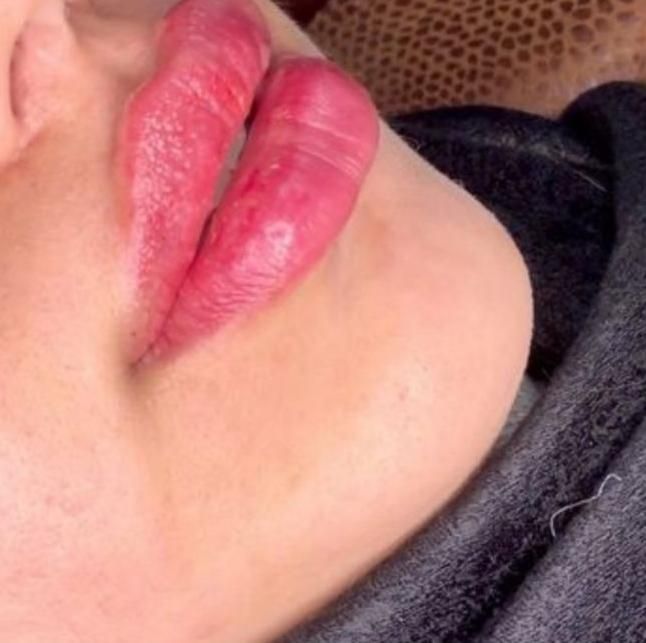 تزیق فیلروبوتاکس لیزر موهای زائد هایفو خالبرداری|خدمات آرایشگری و زیبایی|بوشهر, |دیوار