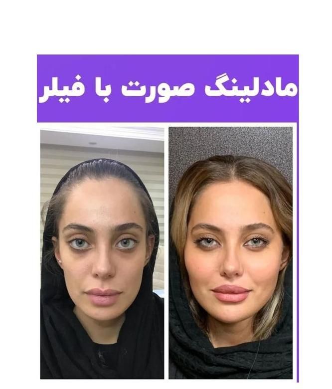 فیلرژل بوتاکس پی ارپی لاغر تزریق چربی مزولیزرهایفو|خدمات آرایشگری و زیبایی|تبریز, |دیوار